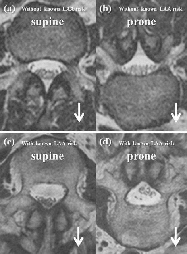 Four black-and-white MRI images.