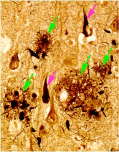 アルツハイマー病の脳では老人斑（緑矢印）と神経原線維変化（桃矢印）が蓄積し、これらが原因となって神経細胞が脱落することにより認知症が生じます。