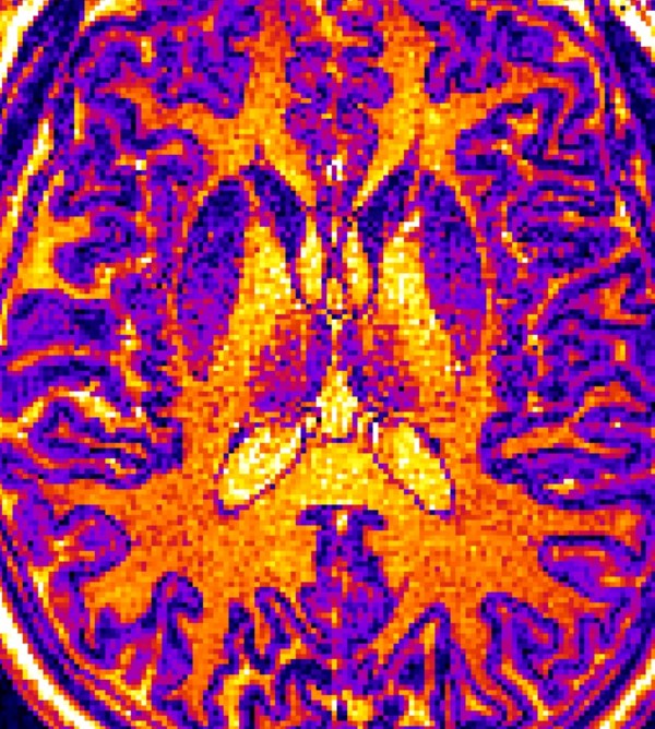 Magnetic resonance imaging image of an adult human brain.