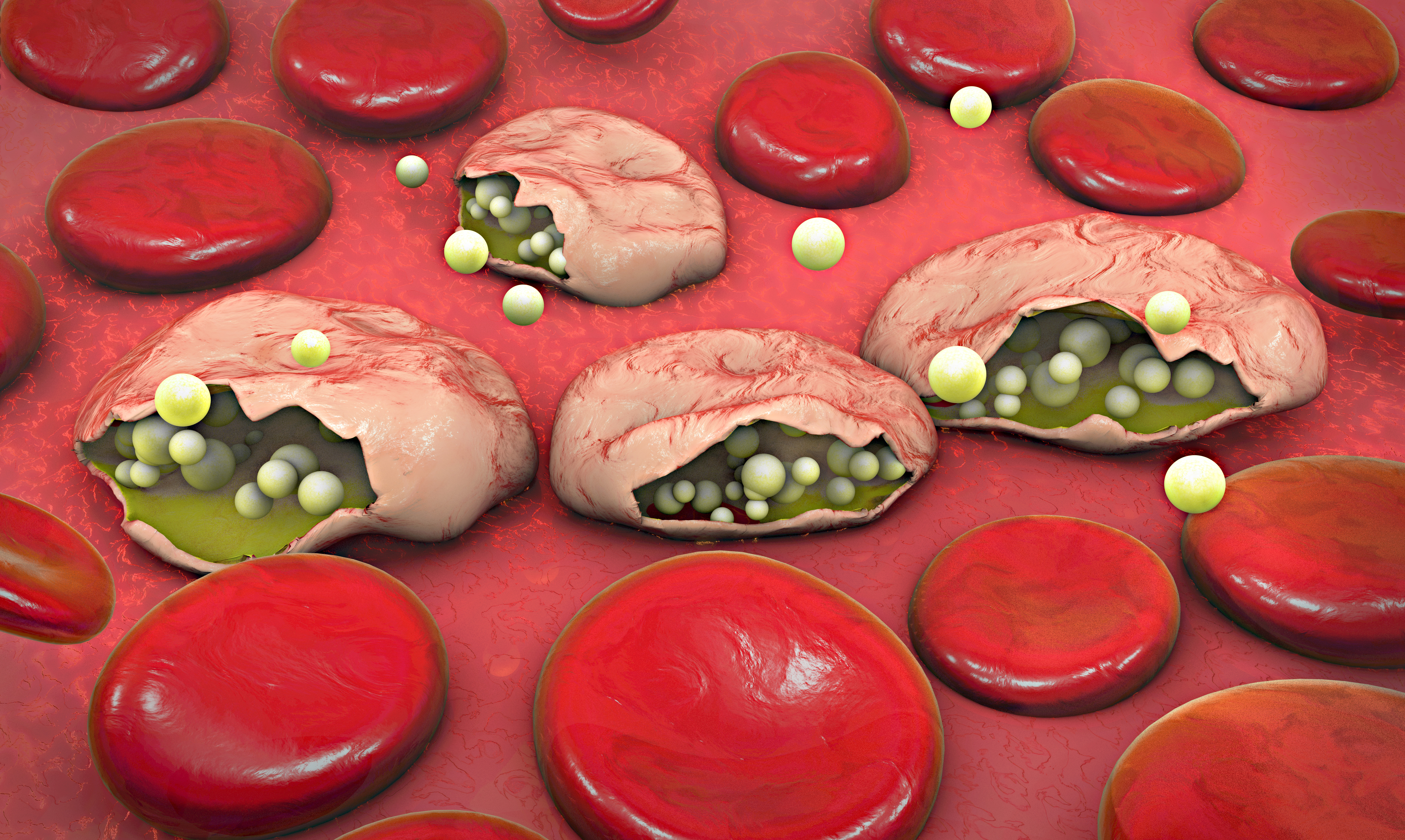 Computer drawn illustration of many red blood cells, four of which are a lighter, unhealthy-looking color and appear to be burst open with yellowish spheres leaking out.