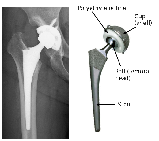 Long Life Artificial Hip Joint Reaches The Bedside Utokyo Research