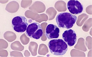 Leukemia cells in peripheral blood © 2012 Toshiki Watanabe