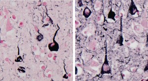 Neurofibrillary tangles observed in the brain of a human Alzheimer’s disease patient (left, black part), and neurofibrillary tangles observed in the brain of a Tsushima leopard cat (right, black part). © James K. Chambers