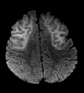 © Masashi Mizuguchi. けいれん重積型（二相性）急性脳症の頭部MRI拡散強調画像。発症（熱性けいれん重積）の3～5日後に大脳皮質下白質に高信号病変が出現する。この症例では両側の前頭葉に病変が認められた。