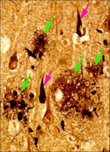 Figure 1: Brain tissue of an AD patient