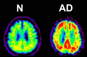 Figure 4: Amyloid PET (Positron Emission Tomography)