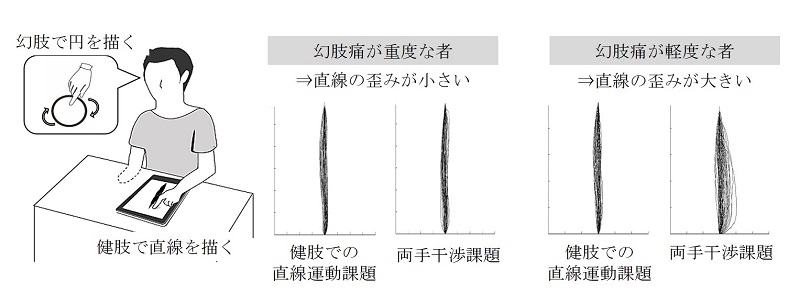 幻痛と関連痛