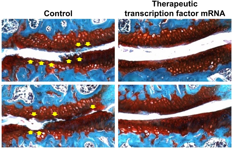Suppression of osteoarthritis progression by in-joint delivery of transcription factor mRNA that promotes cartilage formation © 2016 Hailati Aini.Articular cartilage is stained in red. Curling, degeneration and abrasion of the articular cartilage surface (yellow arrows) are suppressed in the therapeutic transcription factor RUNX1 mRNA-injected group compared with the control group.