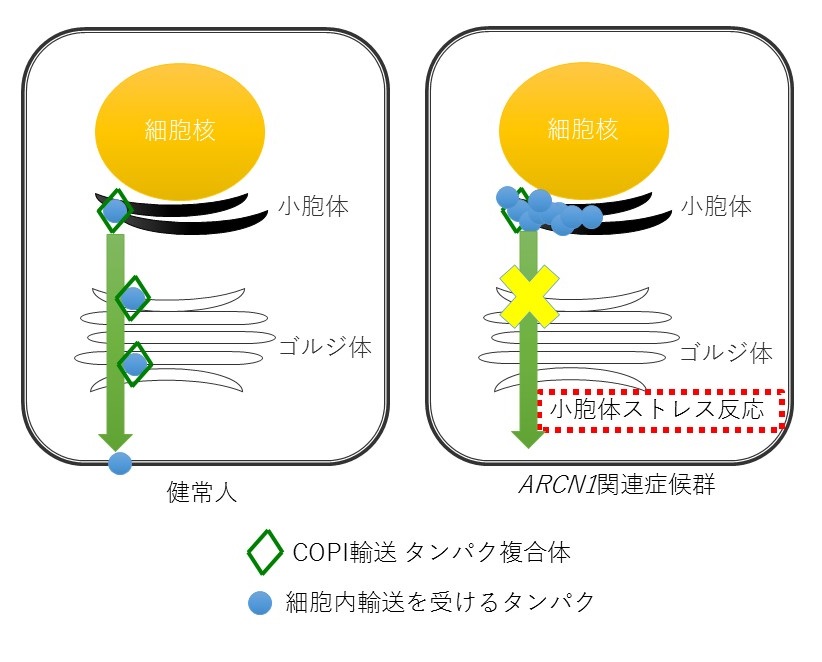 © 2016 Kosuke Izumi.ARCN1は細胞内の輸送を司るCOPI輸送タンパク複合体の一部である。ARCN1関連症候群ではARCN1遺伝子の変異により、細胞内の輸送が害され、適切に修飾を受けていないタンパク質が細胞内に蓄積し、小胞体ストレスが引き起こされる。そして、コラーゲンもCOPI輸送タンパク複合体で細胞外に輸送されるため、同様に細胞内に蓄積してしまう。その影響で、細胞外に分泌されるコラーゲンも減り、結果として、小顎症や低身長といった症状が引き起こされる。