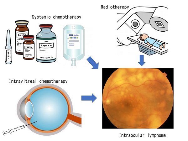 Illustration depicting three-way combination therapy for intraocular lymphoma © 2017 Toshikatsu Kaburaki.The triple therapy, combining local chemotherapy, systemic chemotherapy, and radiation therapy, strongly suppresses brain recurrence of intraocular lymphoma.