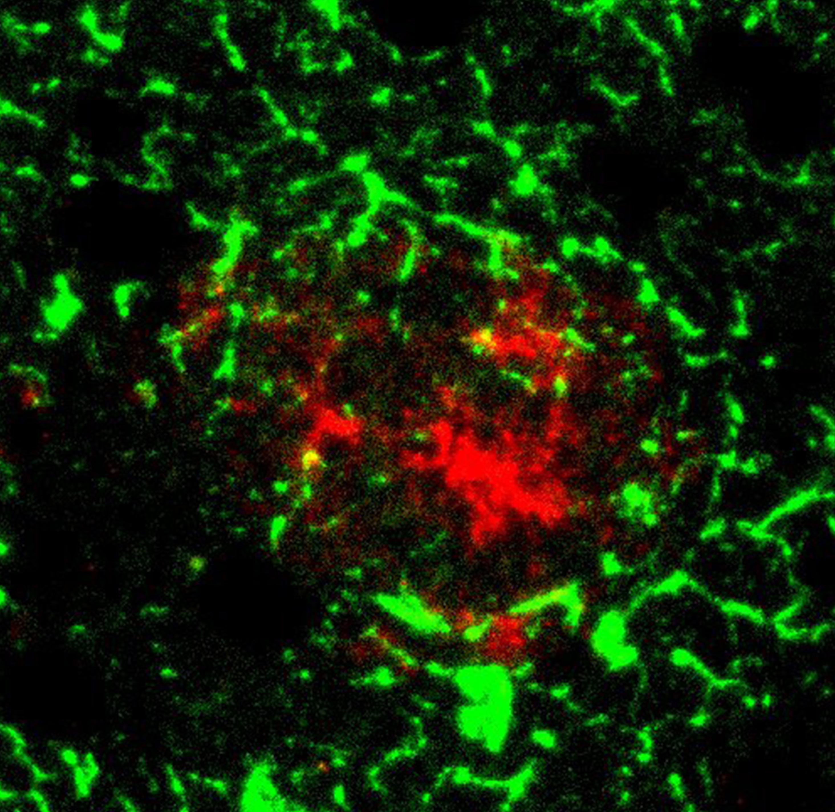 Activated astrocytes and amyloid beta deposit