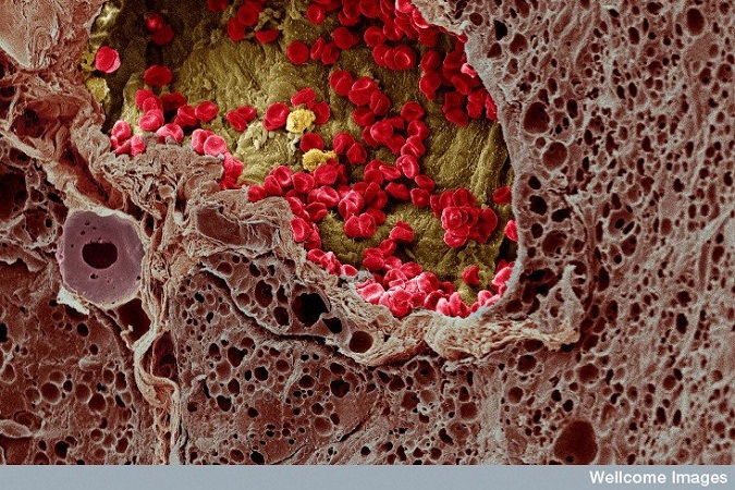 A microscopy image of human tissue showing a melanoma tumor and red and white blood cells with false color added for artistic effect.