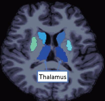 MRI horizontal plane of subcortical brain regions