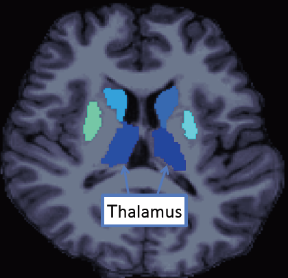 MRI horizontal plane of subcortical brain regions MRI horizontal plane of subcortical brain regions