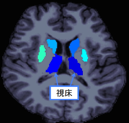 大脳皮質下領域構造のMRI水平断面図