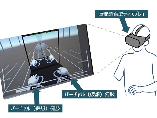 幻肢痛患者さんがバーチャルリアリティー(仮想現実)治療を受けているイメージ図 幻肢痛患者さんがバーチャルリアリティー(仮想現実)治療を受けているイメージ図