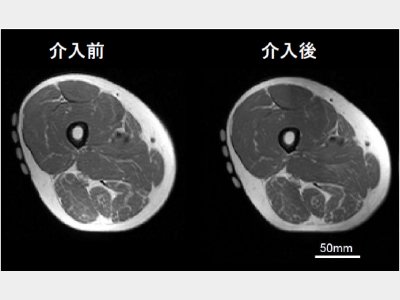 高齢者におけるLST法の効果例（大腿中央部のMRI横断画像）。3ヶ月のトレーニング介入により、大腿四頭筋が肥大した。Watanabe et al. (2014)