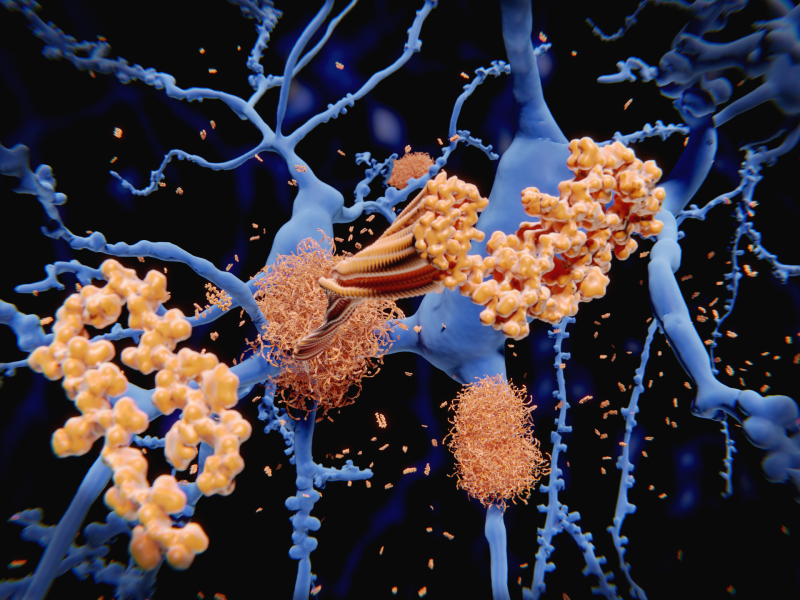 Illustration of amyloid plaques (orange) around neurons (blue)