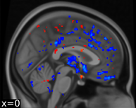 Brain image characteristics related to disease differentiation