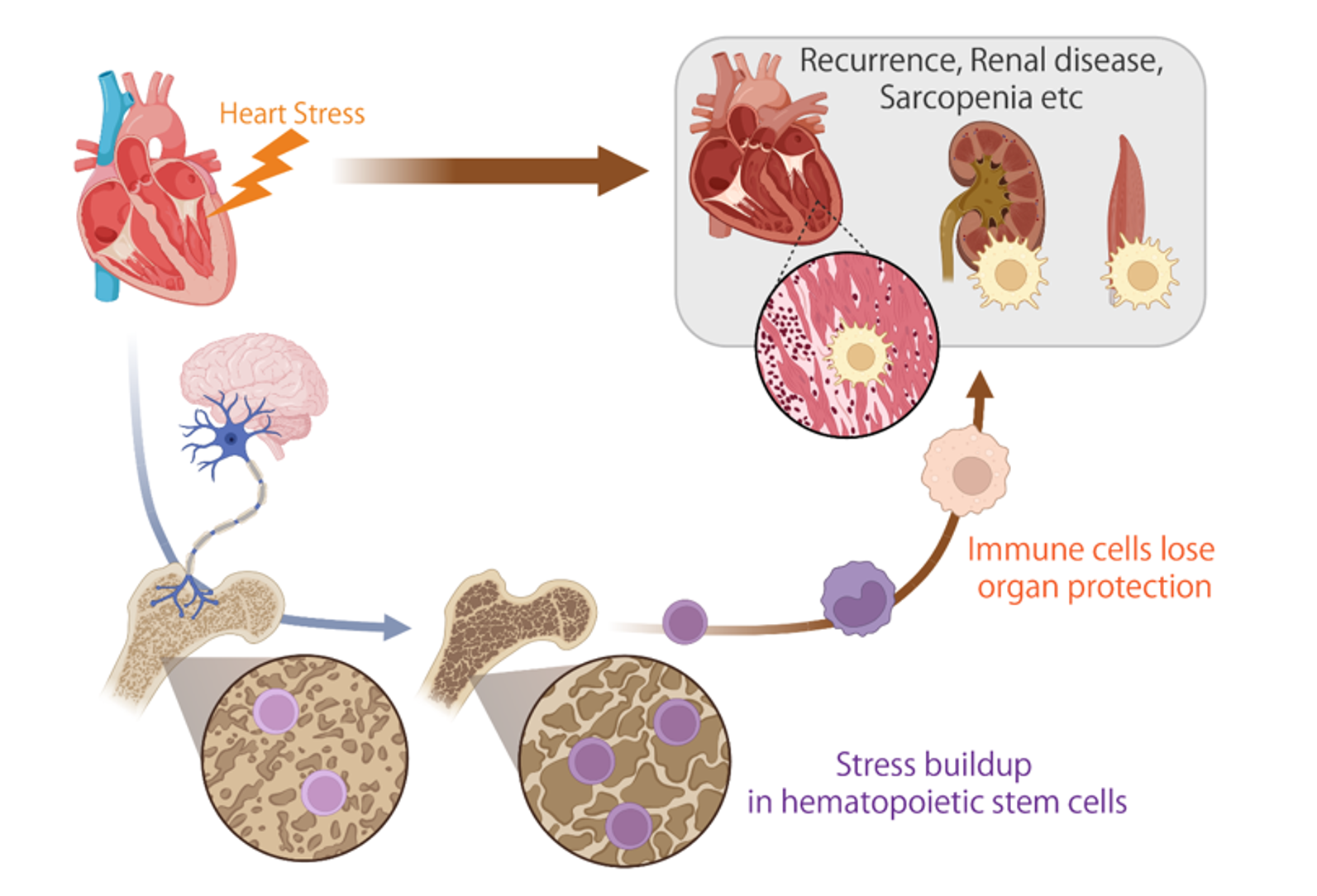 Illustration showing the step-by-step impact of heart failure on immune cell production and body health.