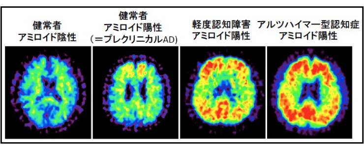 PETでスキャンした脳内の画像