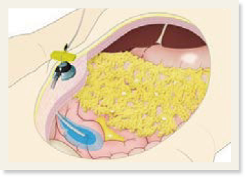 腹部からチューブを通して大腸に抗癌剤を注入している様子を示したイラスト